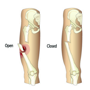 Open and Closed Fractures