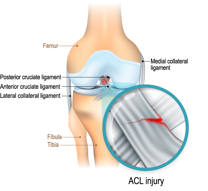 Causes, Symptoms, and Treatment of ommon orthopaedic injuries