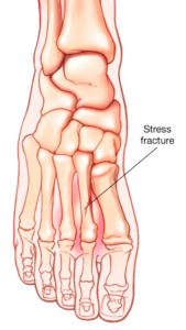 Hairline Fracture