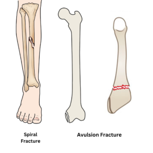 Spiral and Avulsion Fractures