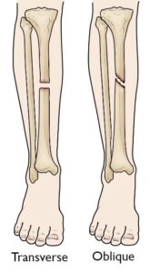 Transverse and Oblique Fractures