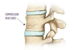 Compression Fracture