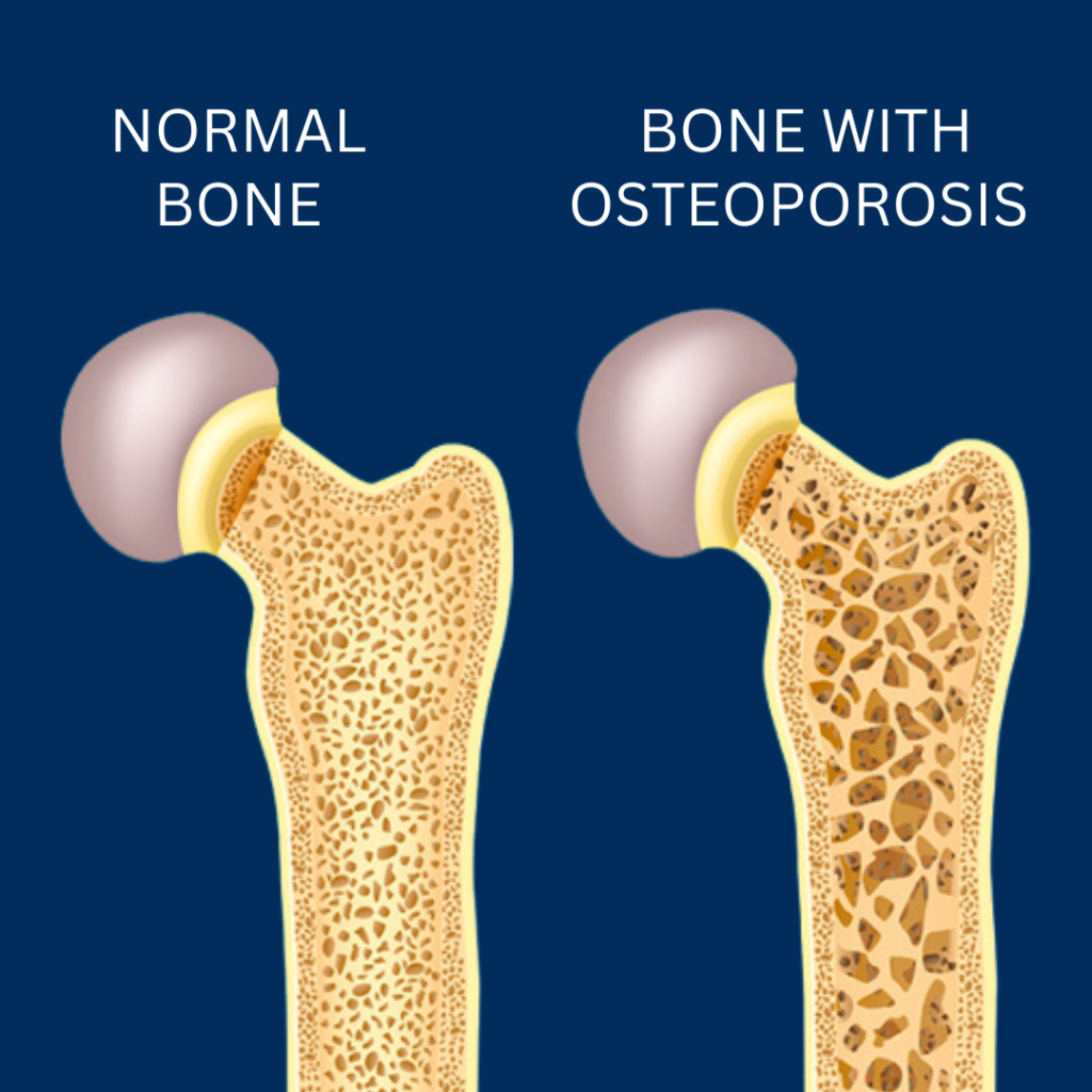 Normal bones vs bones with osteoporosis