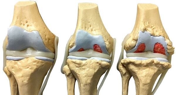 Arthritis of knee joint