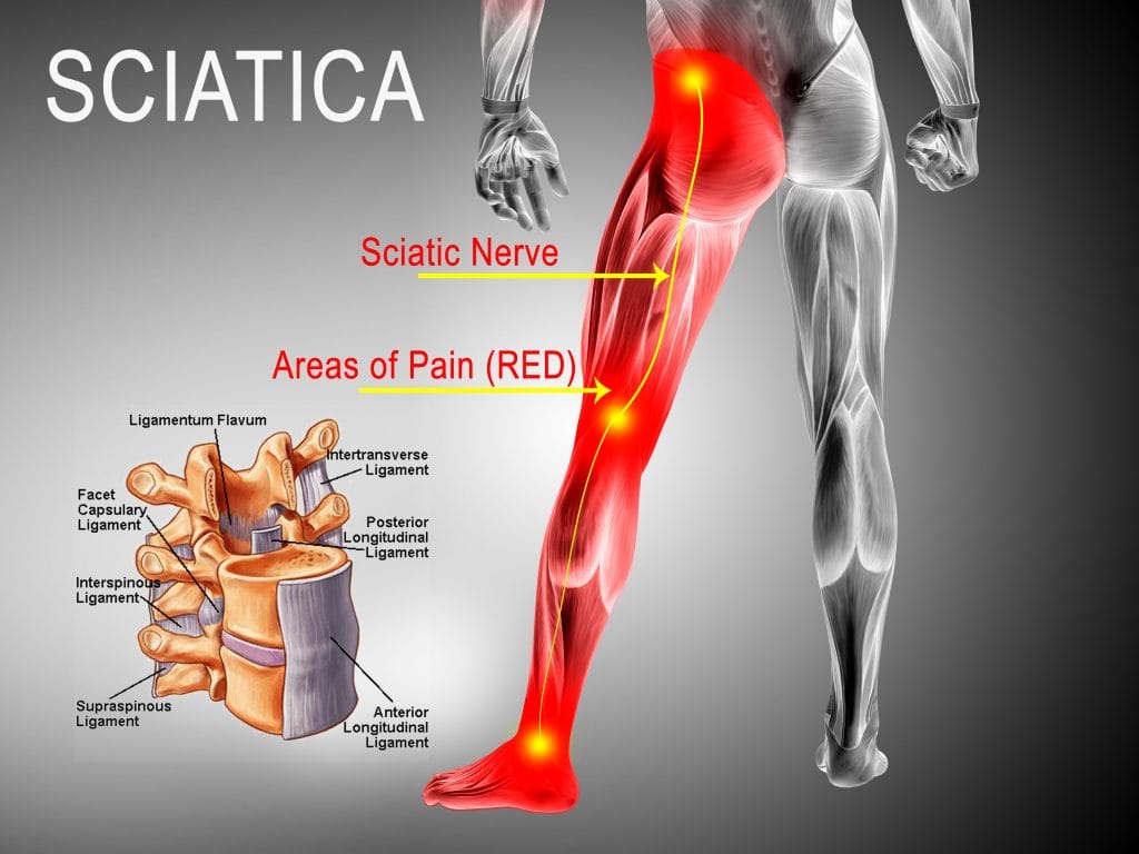 Sciatica Knee Pain  Hip & Knee Orthopaedics