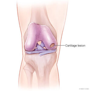 cartilage damage