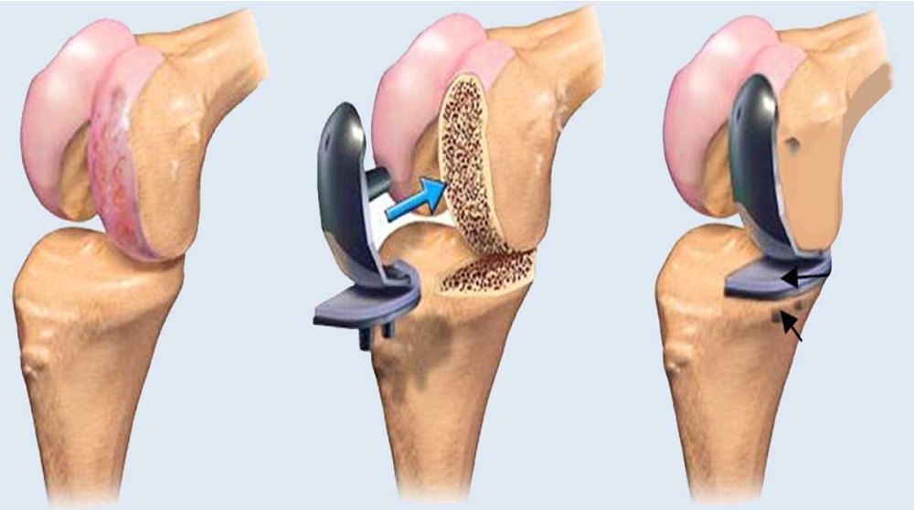 Joint Replacement Surgery, Joint Replacement Surgery