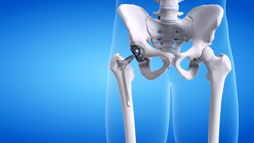 Advancements in Joint Replacement Surgery,