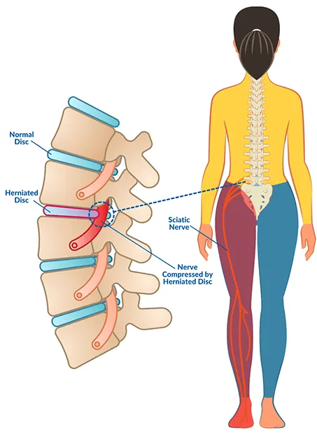 Herniated Discs