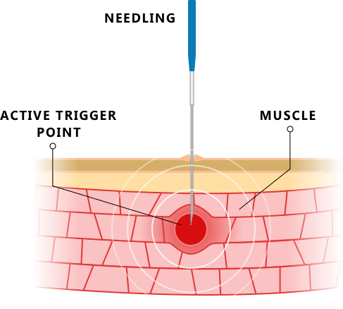 Acupuncture