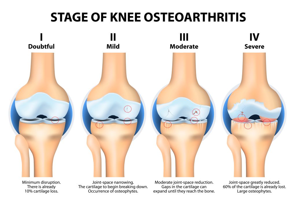 Bone Disease