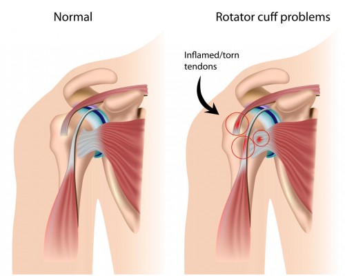 Chronic Tendonitis