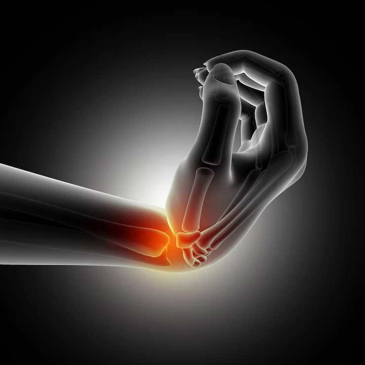 Top 10 Common Orthopedic Surgeries : Joint Fusion