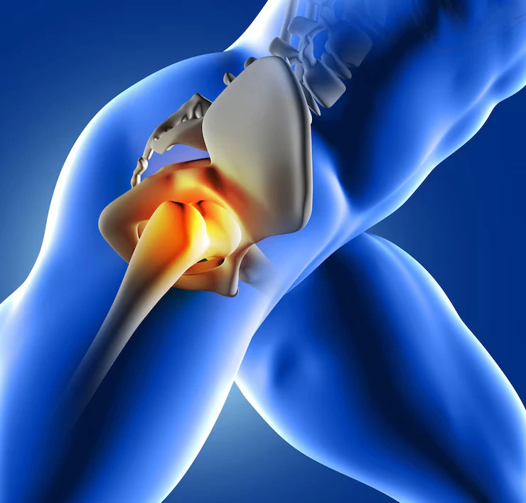 Top 10 Common Orthopedic Surgeries : Hip Replacement Surgery