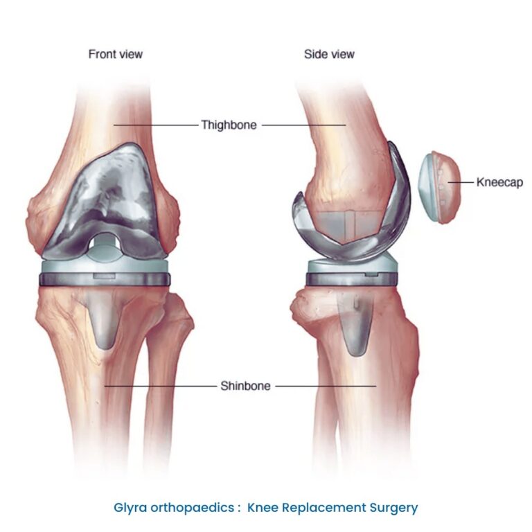 Knee Replacement surgery