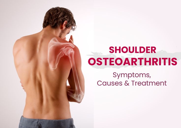 Shoulder osteoarthritis – symptoms, causes & treatment