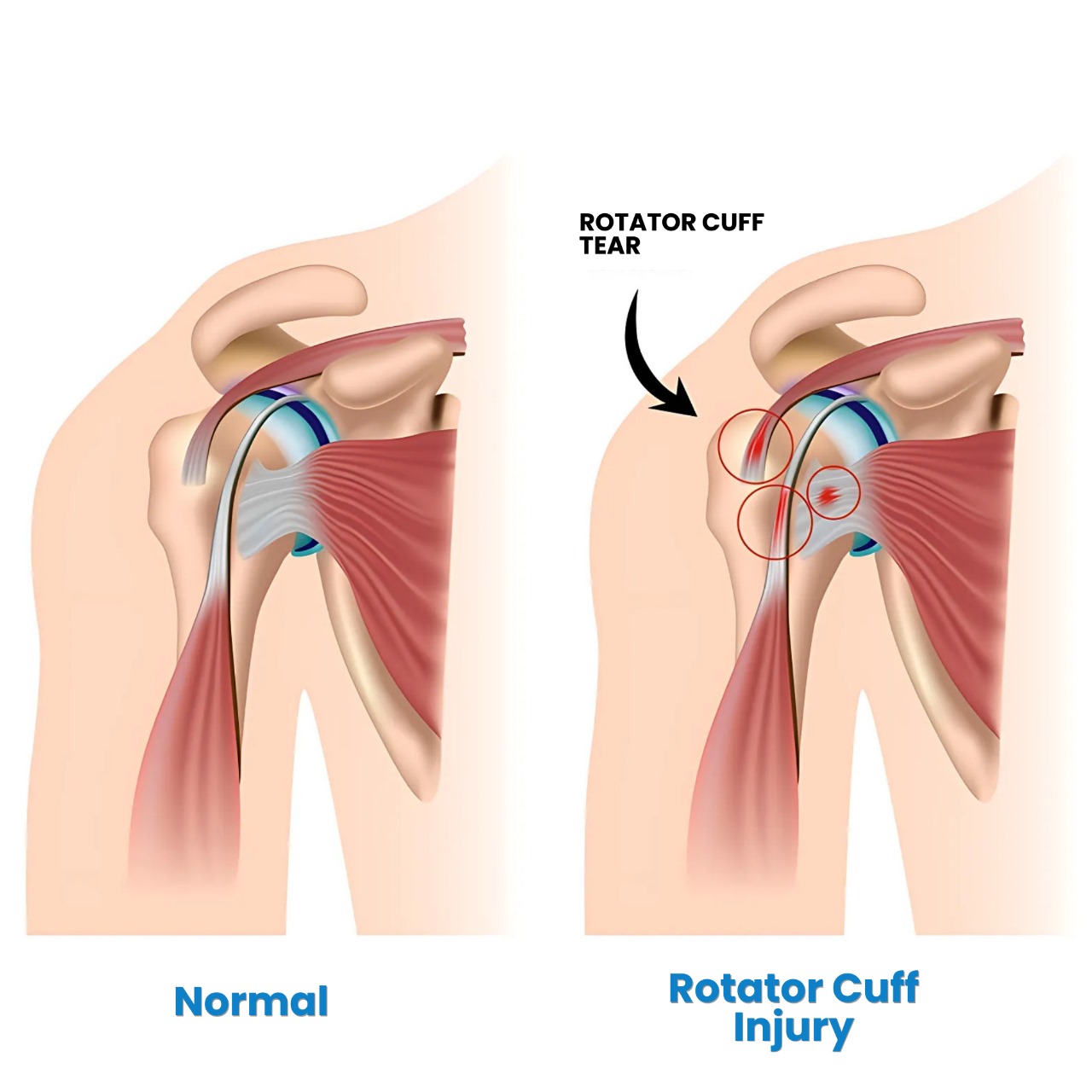 Rotator Cuff Tear: Causes, Treatment, and Recovery