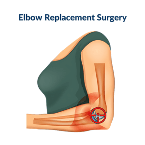 Elbow Replacement