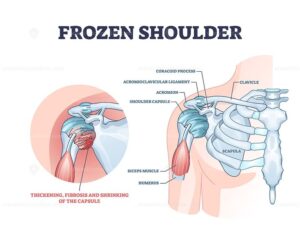  Frozen Shoulder