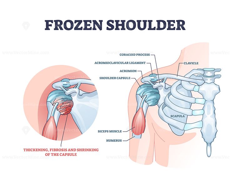 A Comprehensive Guide to Frozen Shoulder Exercises